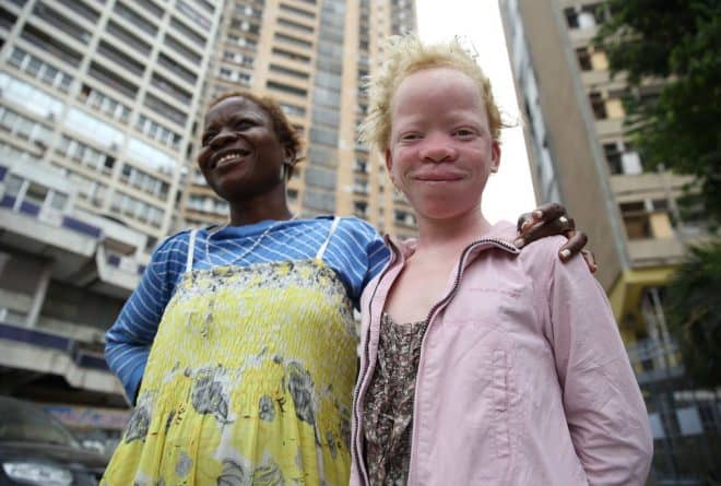 A Goma, les albinos peinent à accéder au marché du travail