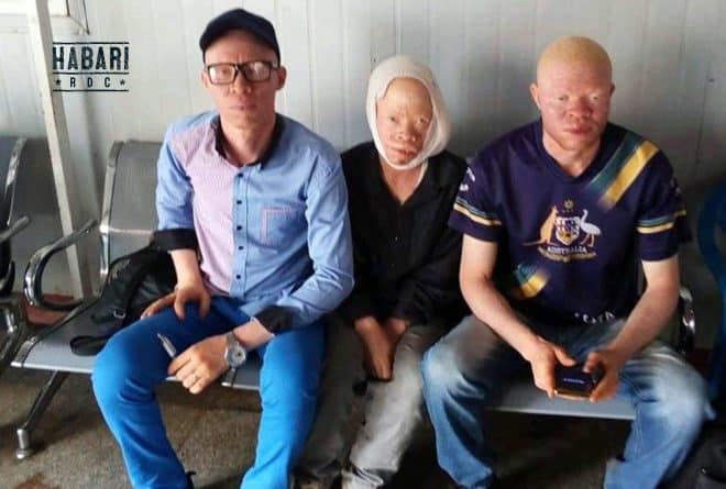 Le fardeau d’être albinos à Lubumbashi