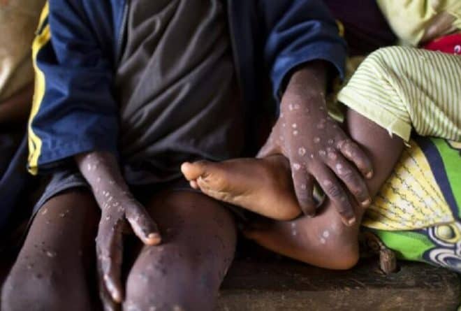 Les mesures pratiques pour se protéger du Monkeypox