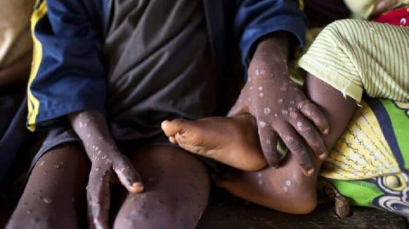 Les mesures pratiques pour se protéger du Monkeypox